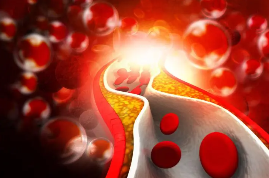 Bendras cholesterolio kiekis – tyrimai ir norma. Kaip  efektyviai sumažinti jo lygį?