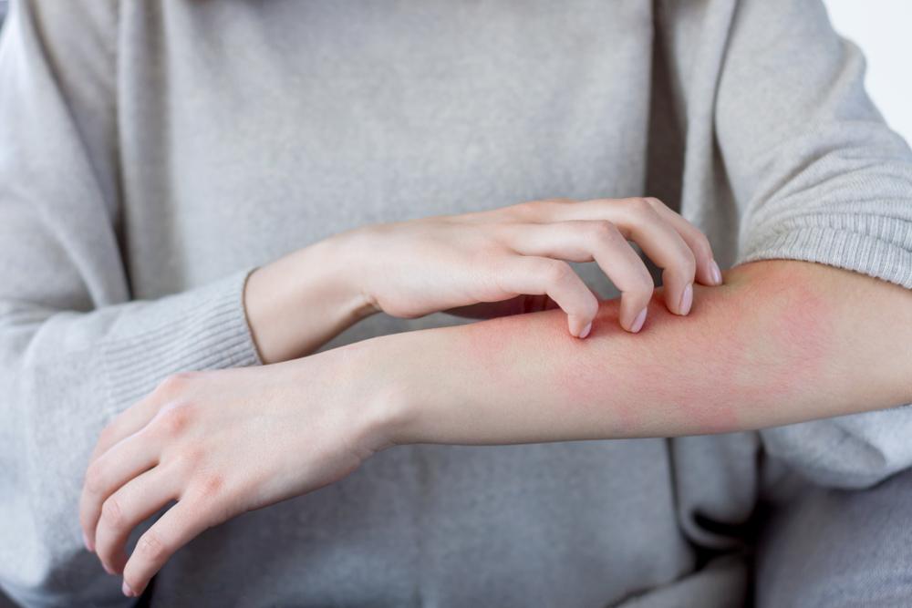 kodėl pasireiškia alerginis bėrimas ir kaip jį gydyti?
